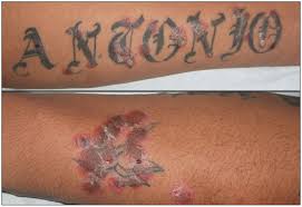 The Koebner Phenomenon Psoriasis In Tattoos Cmaj