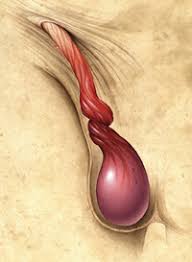 How long after surgery will i have to wait to be sexually active? How Useful Is A Physical Exam In Diagnosing Testicular Torsion Mdedge Family Medicine