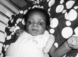 Image result for Kernicterus