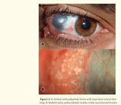 Image result for lesion sclera