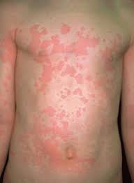 Перевод слова hives, американское и британское произношение, транскрипция, словосочетания, однокоренные слова. Hives Skin Disorders Msd Manual Consumer Version