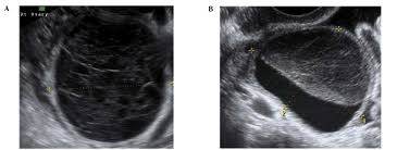 Multilocular cyst, solid areas, bilateral lesions, ascites. The Characteristic Ultrasound Features Of Specific Types Of Ovarian Pathology Review