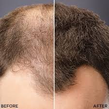 I thought it was a game changer when i first started using it. How To Apply Hair Fibers And More Tips Hairfibers Com