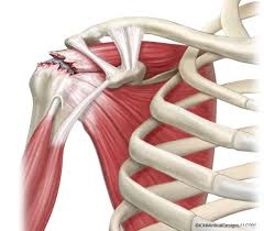 You may find the achilles tendon rupture article more useful, or one of our other health articles. Rupture De La Coiffe Des Rotateurs Clinique De L Epaule A Paris