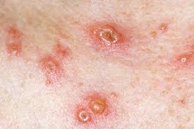 For most children, chicken pox is a mild illness, but there's no way to know which children chicken pox is caused by the varicella virus or varicella zoster virus. Clarendon Lodge Medical Practice Information Zone Chicken Pox