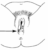 There are many methods available to treat vaginal blisters and sores. Sores On The Genitals Genital Ulcers Hesperian Health Guides