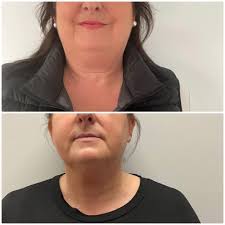 Stellar results after one Skin tightening treatment! New to the menu with a  trial price of $25! This non-invasive treatment will reduces lines,  rehydrate you skin, and increase collegen and elastin in
