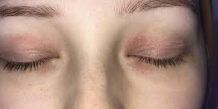 Ist Das Neurodermitis Am Auge Gesundheit
