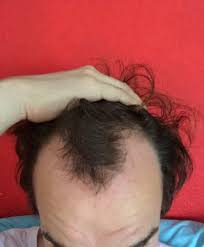 Bei einem jude law macht das nicht viel aus, wohingegen prinz william echt schlimm mmn damit aussieht. Hohe Stirn Und Geheimratsecken Mann 24 Was Gibt Es Fur Passende Frisuren Haare Manner Frisur