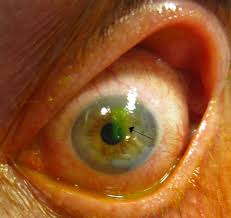 Image result for lesion sclera