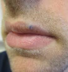 No one exactly knows what causes them. Venous Lake Of The Lip Consultant360