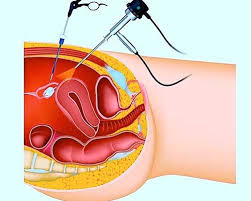 Il sintomo più frquente è il sanguinamento uterino disfunzionale, anche se può anche essere asintomatico. Diagnosi E Cura Dell Endometriosi Seno Clinic