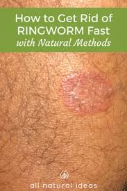 Tea tree oil contains potent antifungal and antiseptic properties that can easily fight off the ringworm infection. How To S Wiki 88 How To Get Rid Of Ringworm Permanently In Hindi