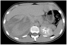 Image result for PECARN Pediatric Intra-Abdominal Injury Algorithm