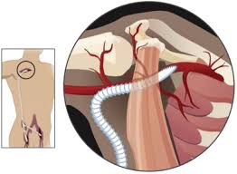 Improved Patency After Axillofemoral Bypass For Aortoiliac Occlusive Disease Journal Of Vascular Surgery