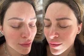 Ditch the Foundation, Embrace the Glow: Why Skin Boosters Are Your Summer  Skin BFF