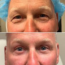 Zip Stitch Closure for Upper Bleph • Lower Blepharoplasty- note the  beautiful contour from lid to cheek after conservative fat removal followed  by fat grafting. #eyelidsurgery #blepharoplastysurgeon #blepharoplasty  #lowerblepharoplasty #asoprs ...