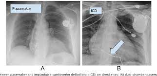 While pacemaker's job is to treat slow heart rate, icd's job is to treat very fast chaotic heart rhythm. Figure 2 From Evaluation And Monitoring Of Patients With Cardiovascular Implantable Electronic Devices Undergoing Noncardiac Surgery Semantic Scholar