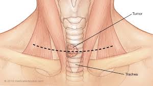 The earlier a cancer is picked up, the easier it is to treat it and the more likely the treatment is to be successful. Diseases Of The Trachea And Airway Department Of Cardiothoracic Surgery Stanford Medicine