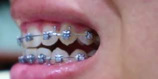 The titanium parts are also used but it is quite rare. Are Damon Braces Really Better Than Regular Braces Top Dentist Reviews