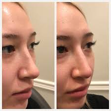 If you have wide nostrils, bring your contour lines down and onto the front of your nostrils. The Non Surgical Rhinoplasty Everything You Need To Know