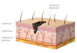 Das maligne melanom ist ein aggressiver, von den melanozyten ausgehender tumor der haut. Schwarzer Hautkrebs Symptome Stadien Behandlung Pflege De