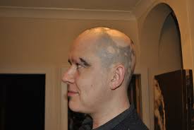 Alopecia Barbae From Hair To Eternity