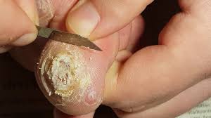 Both, however, are caused by the same thing; Plantar Wart Removing Part 3 3 3 Dornwarzen Etnfernen Teil 3 3 3 Youtube