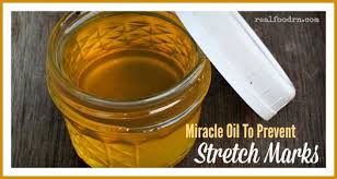 Minimize stretch marks with most effective remedies, boost collagen production, and heal your skin! Miracle Oil To Prevent Stretch Marks Real Food Rn
