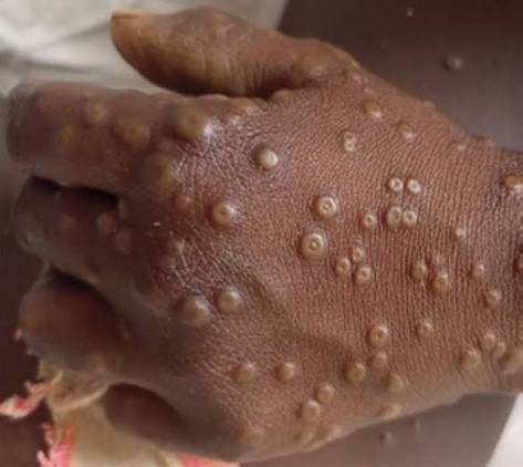 The history of mpox: from the very first cases to new findings |