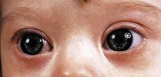 Epicanthic fold, fold of skin across the inner corner of the eye (canthus). Chromosome Disorders Clinical Gate
