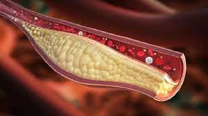 Arterias Entupidas Sinais Como Evitar