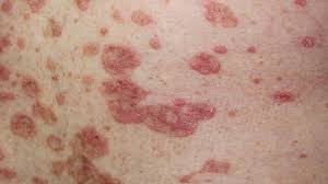 The most common symptoms of lupus include skin rashes and arthritis, which are often accompanied by fatigue and fever. How To Identify Rashes And Other Lupus Skin Symptoms Everyday Health