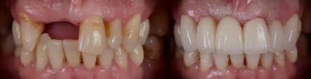 This article has given me more confidence and. Dentures Before And After Pictures Of Patients European Denture Center