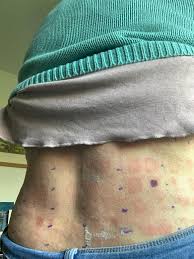 Image result for Patch Testing