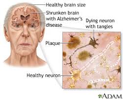 Nursing Care Plan For Alzheimer S Disease