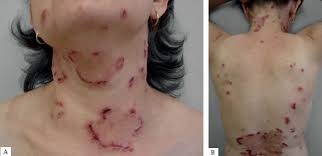 Image result for Linear Dermatitis
