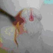 An epispadias is a rare type of malformation in which the urethra ends, in males, in an opening on the upper aspect of the penis, and in females when the urethra develops too far anteriorly. Grup Hipospadia Albajordy45 Twitter