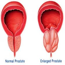Check spelling or type a new query. Symptoms And Types Of Prostate Enlargement Advanced Urology Institute