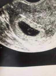 Fruchthohle Vorhanden Aber Baby Nicht Zu Sehen Schwangerschaft