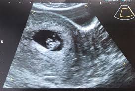 Keep taking your folic acid supplement or a prenatal multivitamin. 8 Week Ultrasound December 2019 Babies Forums What To Expect