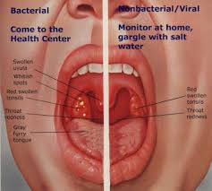 Throat cancer is a general term that applies to cancer that develops in the throat (pharyngeal cancer) or in the voice box (laryngeal cancer). All You Need To Know About A Strep Throat Treatment For Sore Throat Nursing Tips Health