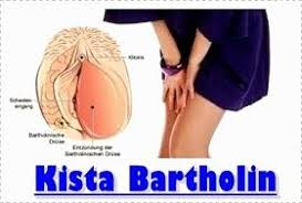 Tanaman Obat Cara Menyembuhkan Kista Bartholin Tanpa Operasi Penyakit Kesehatan Tanaman Obat