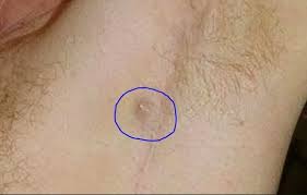 An understanding of the infected ingrown hair in the armpit, swollen lymph node, the home remedies and how to get rid of them. Lump Under Armpit Painful Hard Male Female Sore Small Red Swollen Tender Lump In Armpit Hurts