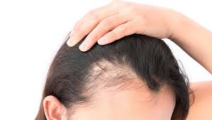 La calvizie negli uomini può comparire fin dai 16 anni · vero · tagliare spesso i capelli contribuisce a rafforzarli e quindi a fermare la caduta . Come Combattere La Calvizia Maschile E Femminile Cause E Rimedi