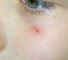 Spider nevus'u olan çoğu insan için tek belirsizlik, gemi kümesinin görünüşüdür. Spider Angioma Ø§Ù„ÙˆØ¹Ø§Ø¤ÙˆÙ… Ø§Ù„Ø¹Ù†ÙƒØ¨ÙˆØªÙŠ