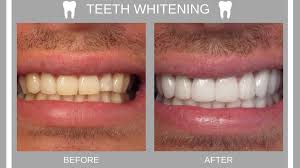 Happy energetic young european guy with. Everything You Need To Know About Teeth Whitening Dr Kevin Sands