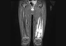 Osteosarcoma of the femur with skip, lymph node, and lung metastases. Rare Surgery Helps Young Patient With Osteosarcoma Remain Active Consult Qd