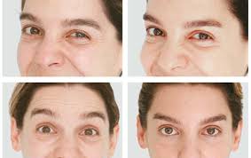 cómo y para qué sirve el botox o la toxina botulínica