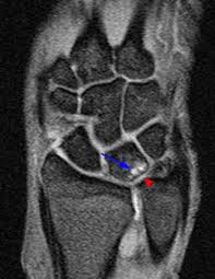 Prognostic Value Of Clinical And Radiological Findings For Conservative  Treatment Of Idiopathic Ulnar Impaction Syndrome | Scientific Reports